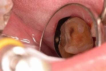 Matrix within a matrix to seal distal margin – Drecomposite