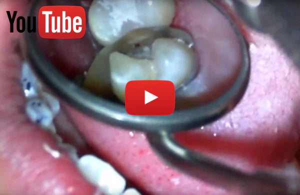 VIDEO: Class II Restoration – Drecomposite